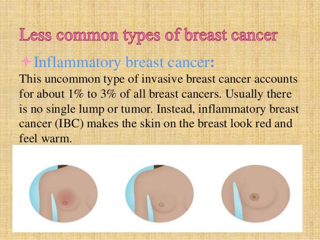 risk factors for inflammatory breast cancer Risk factors for inflammatory breast cancer